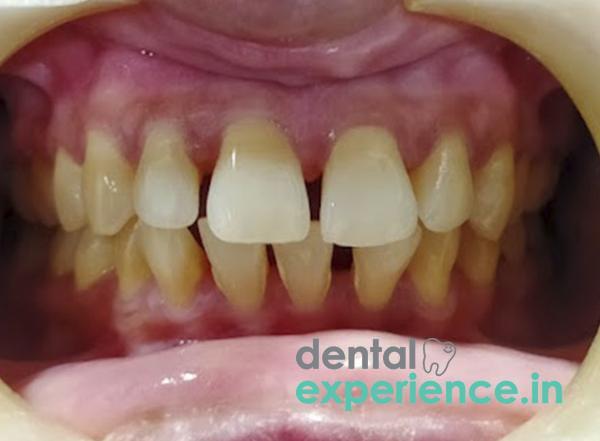 Flared Or Protruding Front Teeth